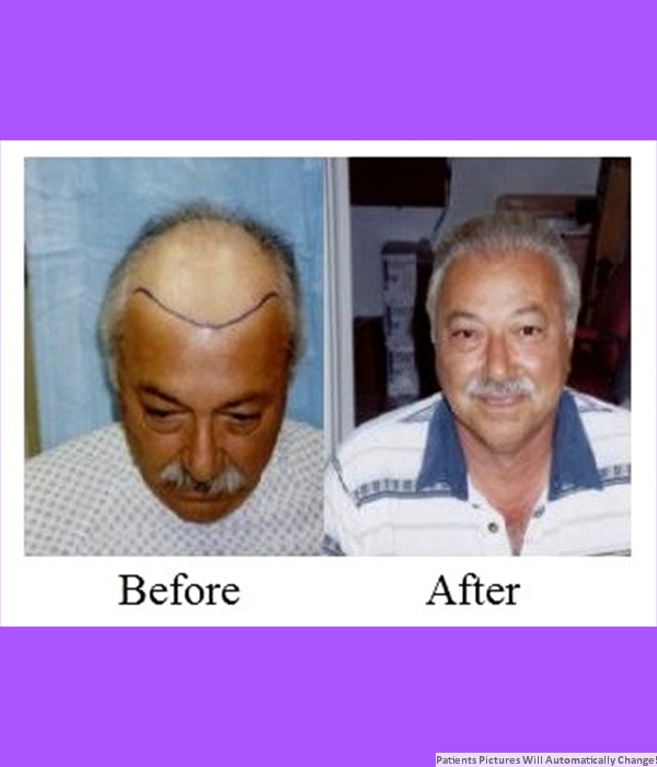  Patient Hair Transplant Cost is $4,000.00