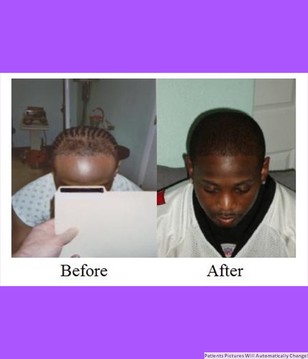 Patient Frontal Hair Transplant Cost is $2,000.00