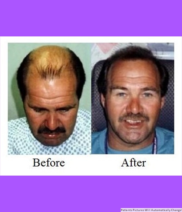  Patient Hair Transplant  Cost is $3,200.00